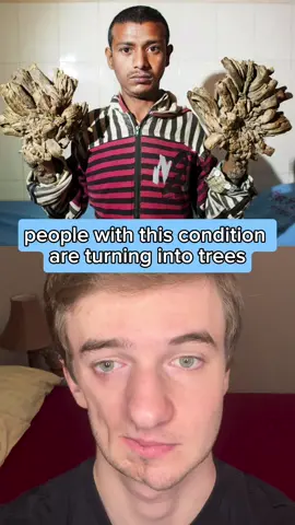 Have you heard of Treeman Syndrome? #tiktokforgood 