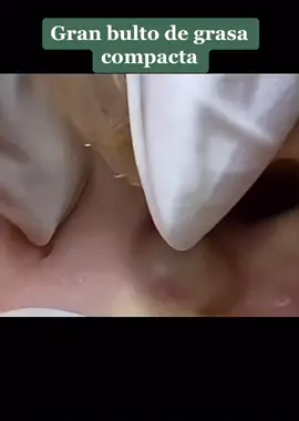 #facial #extraccion #puntosnegros #acne #espinillas #grasa #poros #granos #