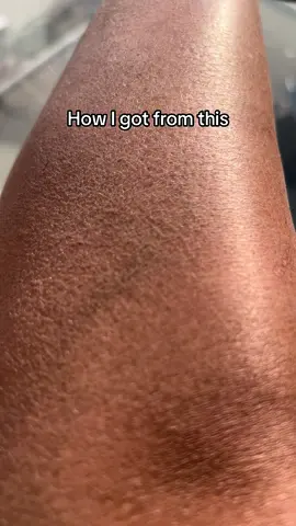 How to treat DRY SKIN 🤍 #skincaretips #skincareroutine #natural #skincare #illuminateglove #dryskin #dryskincare #ingrownhair #flakyskin #exfoliation 