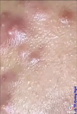 #satysfying #popping #satisfying #Satisfyingvideo #pimplepop #poppingpimples #relax #skin #SkinCare #pimple 17 ● #blackheadremoval #spotsqueezing #puntineriviso #blackhead #acnepatches #puntonerogigante #spots #brufolone #acne #hydrocolloidpatches 