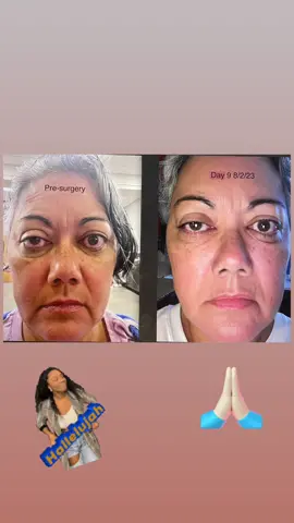 What a big difference 9 days makes. Still need another surgery on the left upper eyelid but overall I am happy with the progress. #thyroideyedisease #gravesdisease #thyroidproblems 