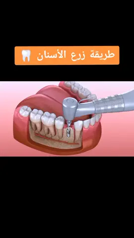 #CapCut طريقة زرع الأسنان 🦷#طب_اسنان #Dctor_denth #طبيب_أسنان_اسطنبول🦷 #Dctor #طب_أسنان_تجميل_أسنان #حلم_كل_طليب_أسنان #طبيب_أسنان_جدة🦷 #explore #اربيل_دهوك_سليمانية #حركت_اكسبلوار #لايك #متابعه #معلومات_مفيده 
