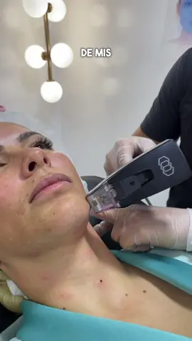 #morpheus ANTES Y DESDUES DE LA PRIMERA SESION - DISMINUCIÓN DEL 40 %  DE LOS SURCOS NASOGENIANOS Y MEJORÍA DE LA MARCACION MANDIBULAR  Y PAPADA