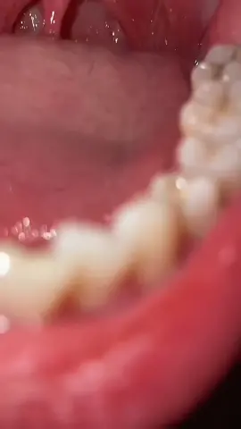 #dentistry #fypagetiktok #lipglossssssssss #oral #beautygirl #smoothlips #fypシ゚viralvideo 