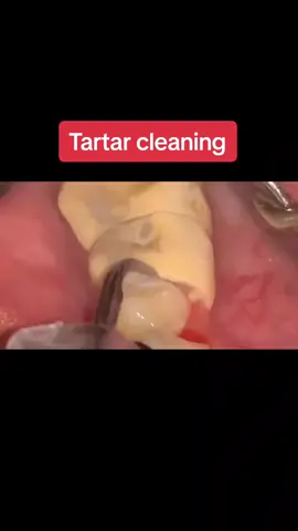 Tartar cleaning #foryoupage #dentist #denimyourway #dentistry #dentista #dentistrylife #tartar 