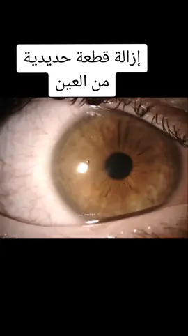 إزالة قطعة حديدية من العين #العين #draem #تيك_توك #tiktok #operation #trending #laafari #جراحة 