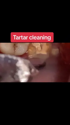 Tartar cleaning #foryou #cleaning #tartar #dentistrylife #dentista #dentistry 