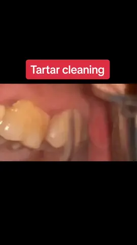 Tartar cleaning #foryou #cleaning #tartar #dentistrylife #dentista #dentistry 