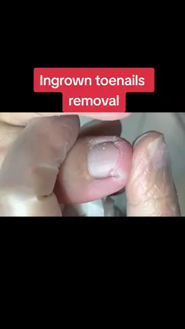 Ingrown toenails removal #nailremoval #toenail #nailtech #nails #ingrown #ingrowntoenail 