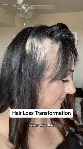 Hair Loss Transformation #hairloss #hairgrowth #alopecia 