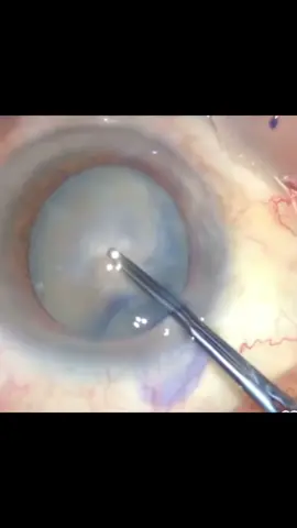 Cirurgia de CATARATA em um paciente cego. Substituímos o cristalino opaco (lente natural) por uma lente artificial para restabelecer a visão.  👁️CURIOSIDADE: 👀Catarata é a principal causa de cegueira reversível no mundo 👀Mais comum em idosos, porém pode ocorrer em qualquer idade 👀Diabetes, cigarro, corticoide podem acelerar a progressão da catarata.  😎Já realizamos mais de 700 cirurgias na clínica SAUBE Gostou? Compartilhe para quem precisa :) 28999502525