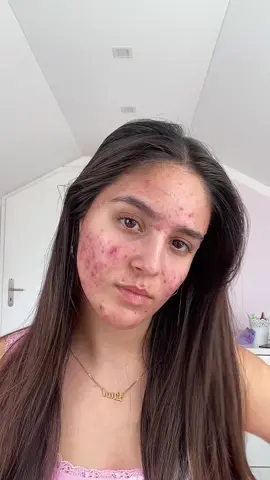 your favourite acne girl #akne #grwm #realskin #skinpositivity #fyp #girls 