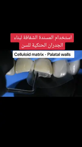 Celluloid matrix - Palatal walls@سامر عقاد طبيب اسنان  بناء الاسنان الامامية بالكمبوزيت #compositeveneers #composite  #dental #dentist #dentista #dentistry #infiltration #stomatolog #tooth #teeth  #الأسنان #الاسنان #أسنان #اسنان #حكيم #طبيبة_اسنان #طبيب_اسنان #طبيب_تيك_توك #دكتور_اسنان #دكتور #عيادة #عيادة_تجميل #عيادة_اسنان #كمبوزيت  #دكتور #طبيب_تك_توك #تبييض #تبييض_الاسنان #تبييض_اسنان #تلميع_الاسنان #تبييض_بالليزر #دكتور_اسنان #سن #طب #طب_اسنان #سامرعقاد 
