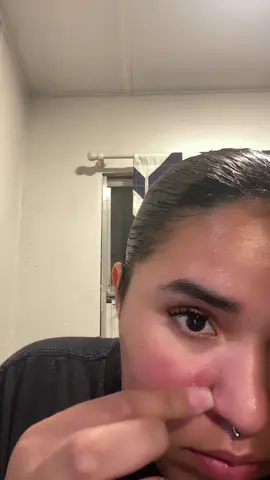 #acne 