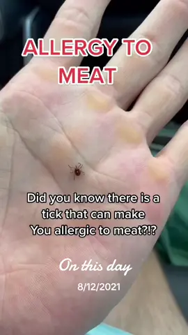 #onthisday #lonestartick #meatallergy #allergy