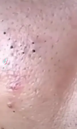 #extractions #puntosnegros #acne #grasa #espinillas #granos #
