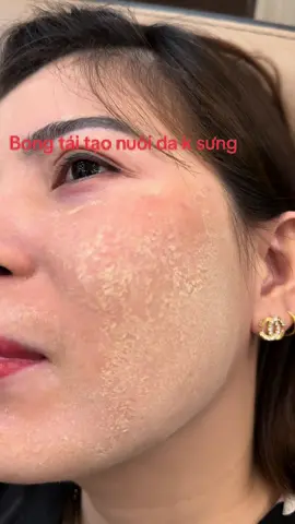 Bong tái tạo nuôi da k sưng đỏ#xuhuongtiktok #điều_trị_mụn_nám_rỗ 