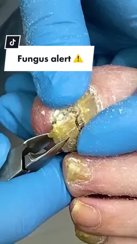 Yellow nail and fungus 😱 #nails #nailfungus #thicknails #toenail #fungus 
