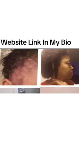 Stop Suffereing From Hair Loss.  Grow your hair back fast usinf all natural Miracle Growth Water #hairproductsthatwork #ricewaterforgair #stophairloss #trending #foryou #hair #stopalopecia 