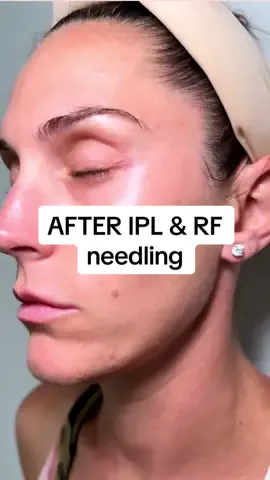 When you have to Chase a patient down for your after photos…. You get them anyway you can! #afterphotos #beforeandafter #skintigheningtreatment #evenskintone #rfneedling #lasertreatments #antiagingskincare #ipllaser #sunspotremoval #sunspottreatment #byebyewrinkles👋 #fyp #foryoupage #comedyvideo #skincaretiktok #skincaretreatment 