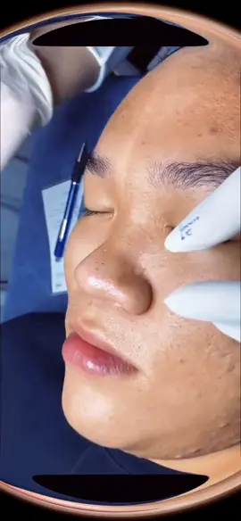 Check for more in Bio #fy #satysfaction #pimples 