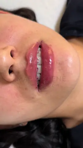 Amando estos labios espectaculares 👄, siempre utilizo las mejores marcas en fillers @marieugeneglamclinic #juvedermlips #lipfillers #medicinaestetica #honduras #aumentodelabios 