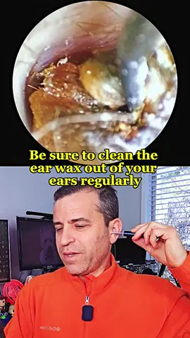 It’s so dirty !!!🤢🤢🤢#earwaxcamera #earwaxclean #earwaxcleaning 