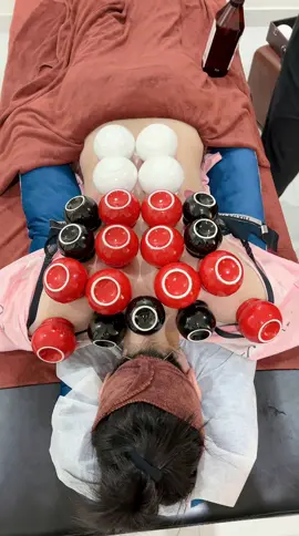 Giác Hơi giải cảm ( Hoả Trị Liệu ) cho Chị em Phụ Nữ.#Giachoi #trilieuhaiphong #massage #LearnOnTikTok #xuhuong 