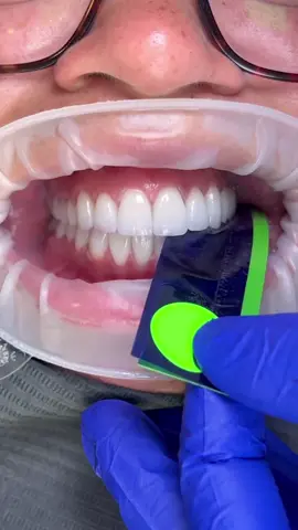 Occlusion check-up ✅️ . . 📽By@smilesbydrp • • --------------------------------------- 📥 Post your case on #dentistry_everyday to get repost --------------------------------------- Like & Follow for the love of dentistry and more such interesting content 💯. • Loved the outcome •  Tag a Friend • ➖ #dentistry_everyday • . #dentistry #dental #dentist #dentists #dentalstudent #dentalhygienist #dentalart #doctor #doctors #toothimplant #dentalrestorations @dentistry.everyday #dentalboards #dentalradiography #dentalveneers #dentalclinic #dentalclinicdesign #dentalimplants #teeth #tooth #dent #dentallogo #dentalassistant #dentalcare #dentalinstruments