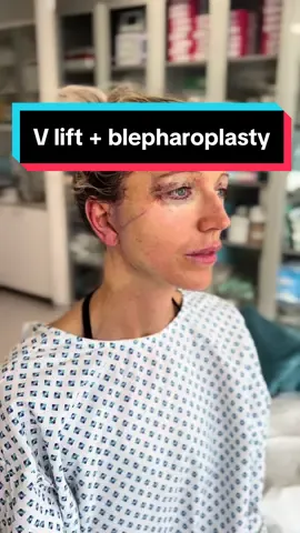 Right after V lift and blepharoplasty. Stay tuned for the result!👀🪄 #plasticsurgery #aftersurgery #facelift #blepharoplasty #vlift #transformation