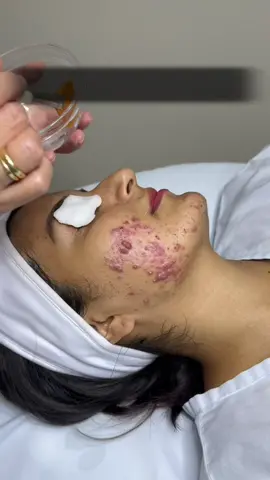 LEE LA DESCRIPCIÓN: El peeling quimico es un tratamiento COMPLEMENTARIO ( mi paciente tiene un tratamiento con medicamentos via oral). Y voy a seguir mostrando su evolucion. Recuerda Si quieres tener exito en tu tratamiento para el acné recurre a un dermatólogo certificado y con experiencia. Manten Un buen regimen de cuidado y ten mucha paciencia y buen humor🥰🤗😄 #fyp #acne #acn #isotretinoina #rocutan #acnotin #peeling #secure 