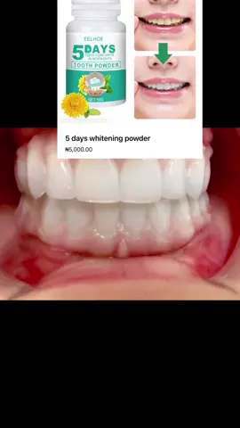 #Kano #dentalhygieniststudent🧑‍⚕️🧑‍🎓 #nigeria #dentalhygienist #health #dentaltherapy #dentaltok 