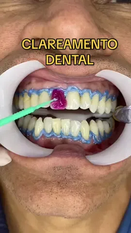 Clareamento dental de consultório, vem ver! #clareamentodental #clareamentodosdentes #clareamento #dentesbrancos 