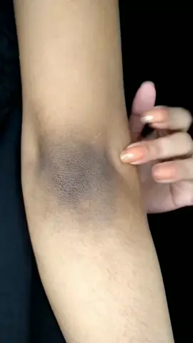 #Dark #Elbows #Remove #easy😍😍😍😍😍😍😍😍😍😍