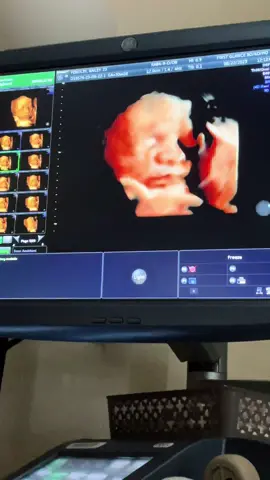 we had our 3d ultrasound today!! it was everything i was dreaming for and more 💗 he is such a little angel—and even though he’s usually so active, he slept the whole time! he was chewing on his umbilical cord 😹 thank you again @First_Glance3D4D 💗🥰 #3dultrasound #4dultrasound #3dultrasoundhdlive #30weeks #30weekspregnant #ultrasound #30weekscan 