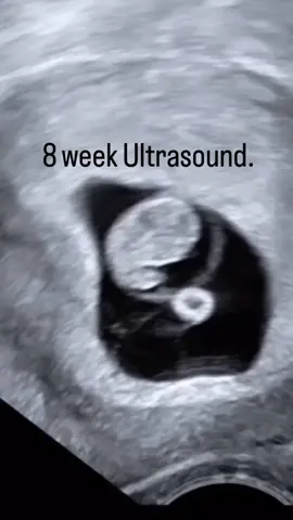 8 week ultrasound #fypシ 