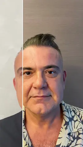 Best facelift for MEN! No scars around the ears!Subperiostal endoscopic facelift  is a scarless technique with no cuts around the ears and no skin removal. It's by entering through a 0.75 inches incision made only through the hair. The subperiostal endoscopic facelift surgery targets the recovery of the entire face & neck and the golden ratio of the face. At the same time in this surgery; + Brow lift, + Lower and upper eyelid aesthetics (Treatment of sagging and bags) + Correction of the eye axis upwards in women and straight in men, + Almond eye (optional) + Rhinoplasty (optional)  + Correction of cheeks and nasolabial grooves, + Bichectomy + Lower face recovery, correction of the chin contour is done. All of them heal at the same time without leaving any visible scars around the ears. The surgery is done through a 2 cm incision in the hair. The operation takes about 1.5-2 hours on average. You stay in the hospital for one night. Return to normal life within 10-15 days. The results are permanent for at least 10-12 years and above. The maximum effect remains for 10-12 years. In fact, many more years you will never go back to your old version. Even though the skin ages, the new facial structure is permanent. 😊 FOLLOW & DM for me for more details please. #facelift #faceliftsurgery #faceandnecklift #necklift #plasticsurgery #bestolasticsurgeon #beforeandafter #beauty #beautifulwoman🥰🥰💓 #formen #formen#man #handsomeman #handsome #manface #manfacefilter #menchallenge #youngerman #oldmanpower #manpower #strongman #mansecrets #manbeauty 