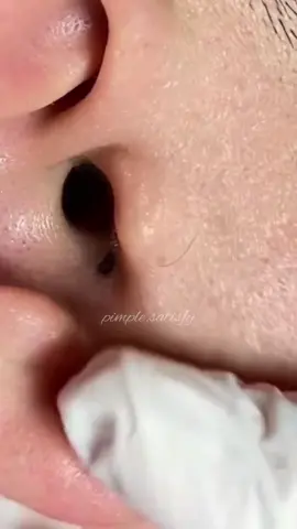 #pimples #satysfaction #fy #extractions #foryou #blackheads #supersatisfying 