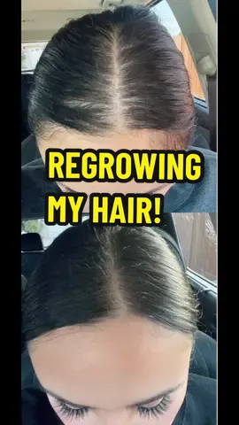 My hair loss restoration journey has taken 6 months. But my before & after pictures were taken 4 months apart. Check out all that new hair growth!!! No more bald spots. The right formula makes a biggest difference. #hair #hairtransformation #hairtok #hairgrowthtips #hairgrowthjourney #hairloss #scalpoiling #hairgrowth #hairlossremedy #hairlosssolutions #hairlossjourney #hairlosstreatment #hairlosstips #hairlosstiktok 