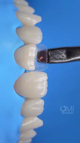 Direct Composite Restoration 🦷🤍 @dentist.4.smile  . #dentistry #composite #directComposite #veneers #veneer #dental #teeth #tiktoklong #trend #viral #dentalclinic 