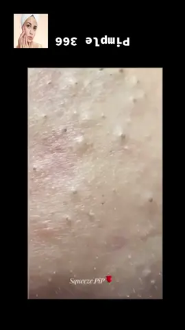 #squeeze #squeezeyuk #acne #pimple #pimplepop #blackhead #satisfying #foryoupage 59