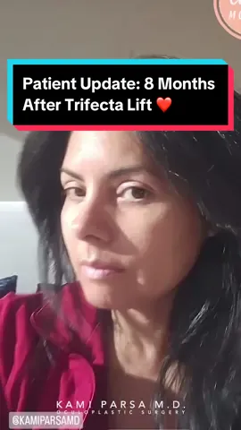 Trifecta Lift = Lower blepharoplasty + fat transfer to mid-face + skin tightening. 📍Beverly Hills, CA 🔗Use link in our bio for pricing & appointments. #eyes #journey #eyemakeup #eyebags #darkcircles #teartroughs #beforeandafter #kamiparsa 