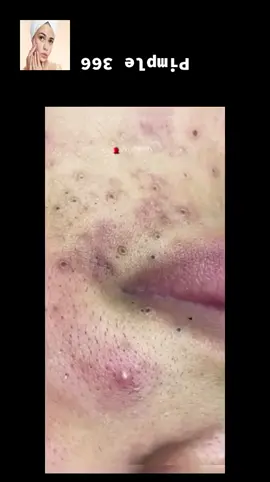 #squeeze #squeezeyuk #acne #pimple #pimplepop #blackhead #satisfying #foryoupage 25