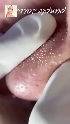 #squeeze #squeezeyuk #acne #pimple #pimplepop #blackhead #satisfying #foryoupage 165