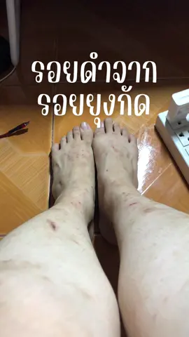 รอยดำจากยุงกัด แพ้น้ำลายยุง #ป้ายยา #tiktokshopครีเอเตอร์ #เจนติดห้องนอน #รอยยุงกัด #plantnery 