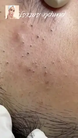 #squeeze #squeezeyuk #acne #pimple #pimplepop #blackhead #satisfying #foryoupage 25