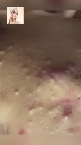 #squeeze #squeezeyuk #acne #pimple #pimplepop #blackhead #satisfying #foryoupage 60