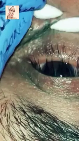 #squeeze #squeezeyuk #acne #pimple #pimplepop #blackhead #satisfying #foryoupage 74