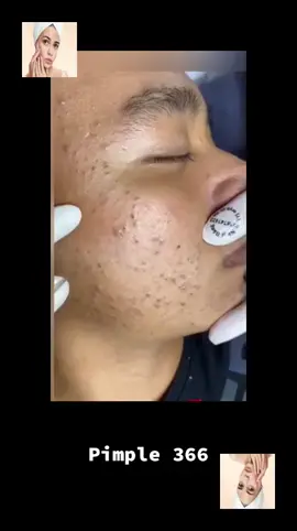 #squeeze #squeezeyuk #acne #pimple #pimplepop #blackhead #satisfying #foryoupage 25