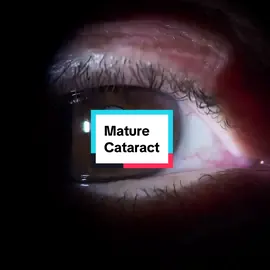 A #cataract is the clouding of the lens inside your eye. It will cause temporary vision loss when it matures. It can be removed with #cataractsurgery 